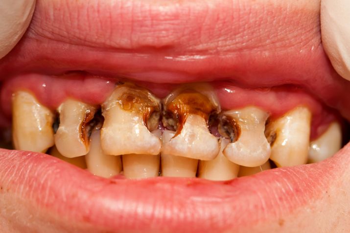 get rid of cavities with nutmeg get rid of cavities with nutmeg - India TV