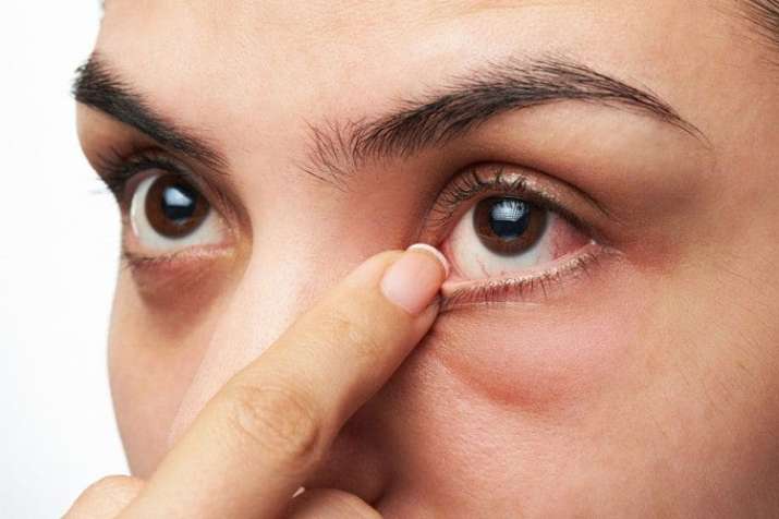 Eyelid Twitching Eyelid Twitching- India TV