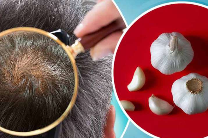 garlic-for-hair-growth-and-get-rid-to-dandruff-know-how-to-use-garlic