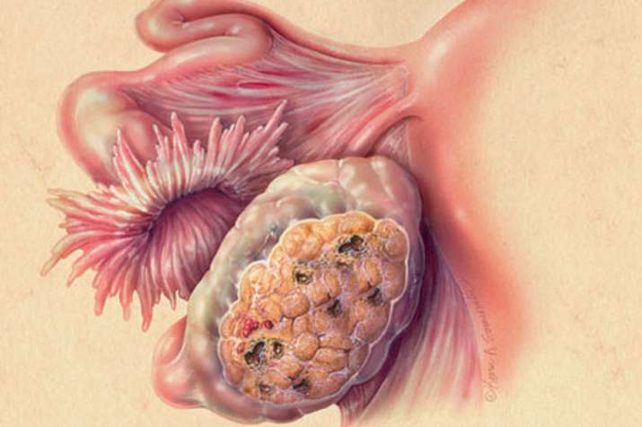 Overian cancer Overian cancer- India TV