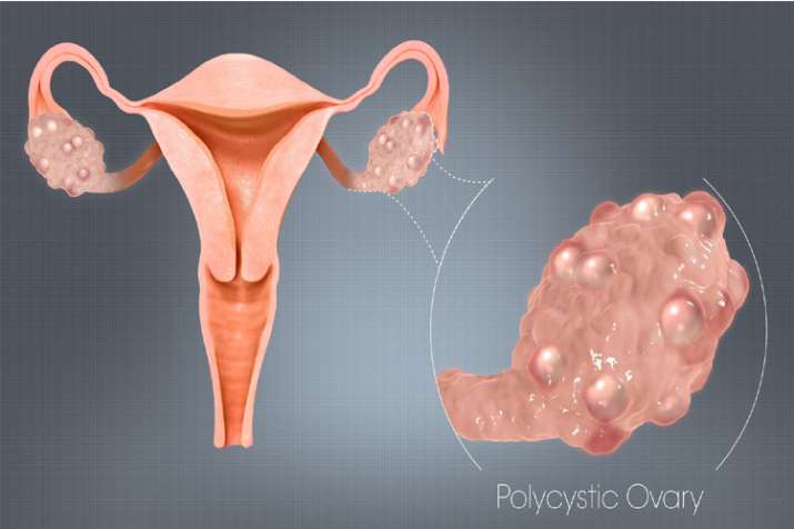 PCOS PCOS- India TV