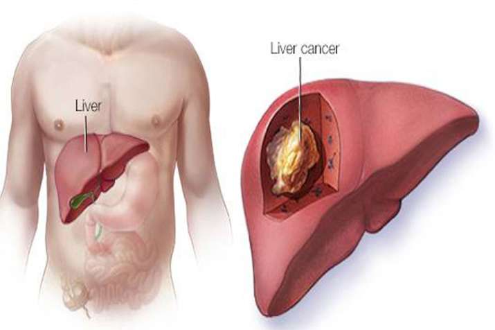 World liver day World liver day- India TV