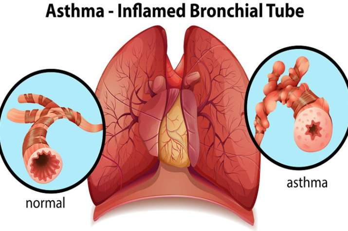 World Asthma day World Asthma day- India TV