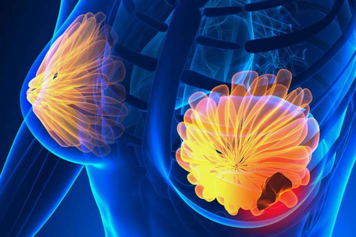 Breast Cancer Breast Cancer- India TV