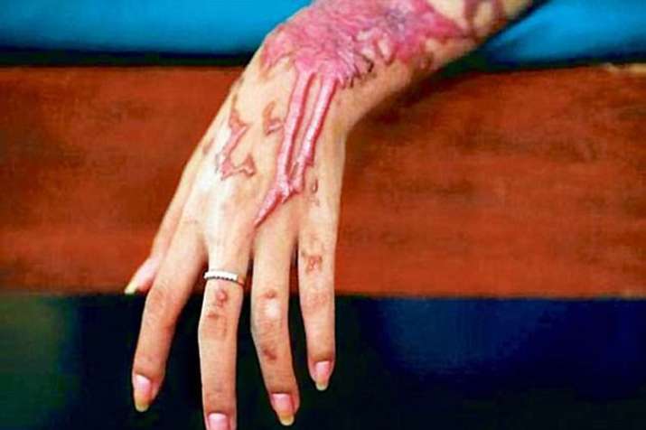Acid Attack Acid Attack- India TV