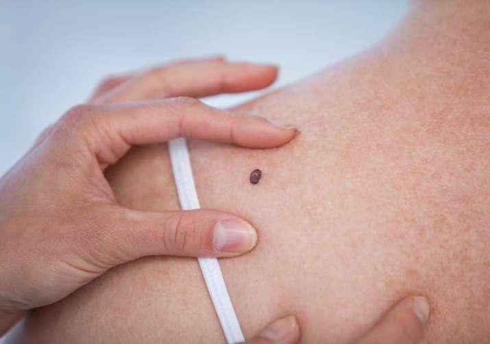 Skin cancer Skin cancer- India TV