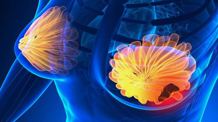Breast cancer Breast cancer- India TV