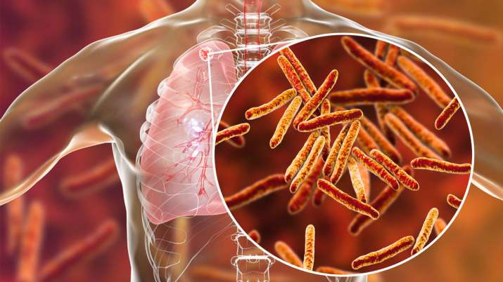 quarter of the worlds population at risk of developing tuberculosis quarter of the worlds population at risk of developing tuberculosis- India TV