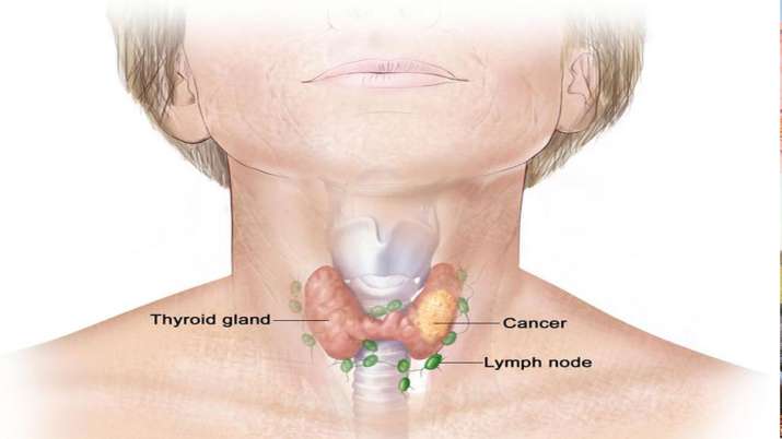 thyroid cancer thyroid cancer- India TV