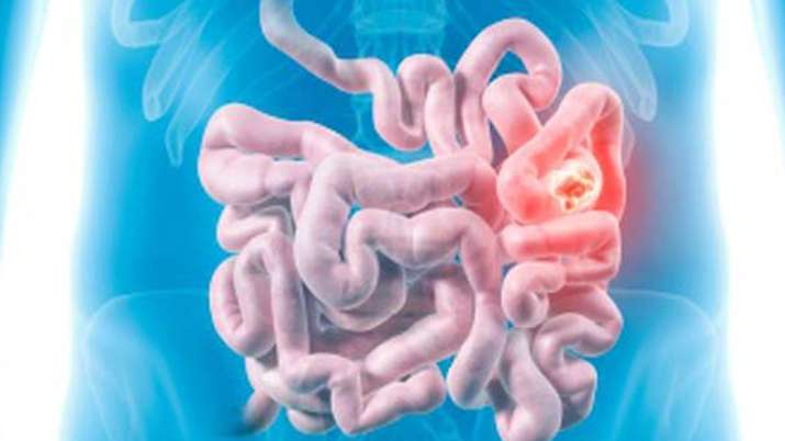 Intestine Intestine- India TV