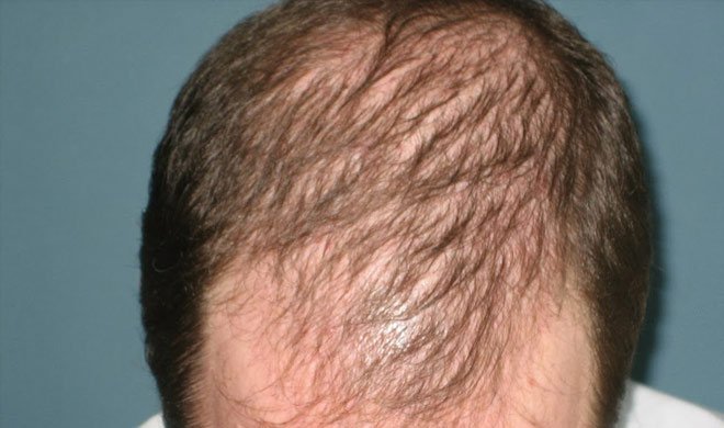 Из за чего могут выпадать волосы на животе у мужчин